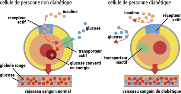 image mécanismes du diabète - insulinorésistance et insulinopénie